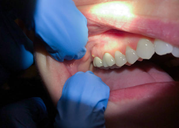Best Emergency Wisdom Teeth Removal in North Beach Haven, NJ